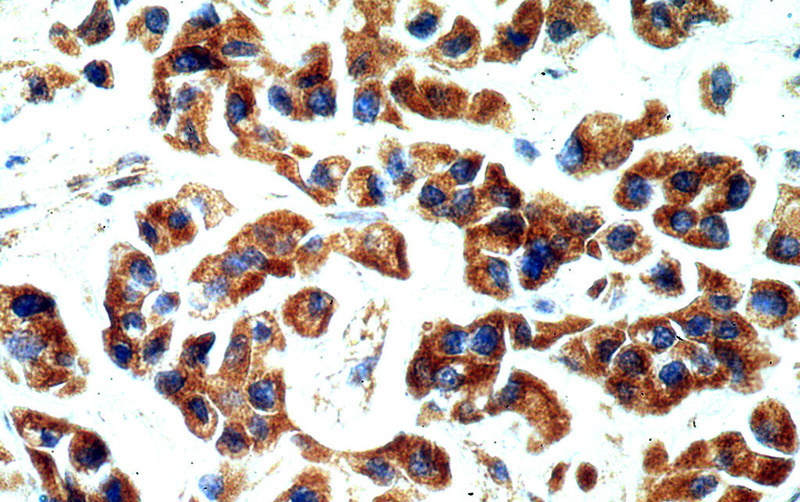 Immunohistochemical of paraffin-embedded human breast cancer using Catalog No:115679(STARD3NL antibody) at dilution of 1:100 (under 40x lens)