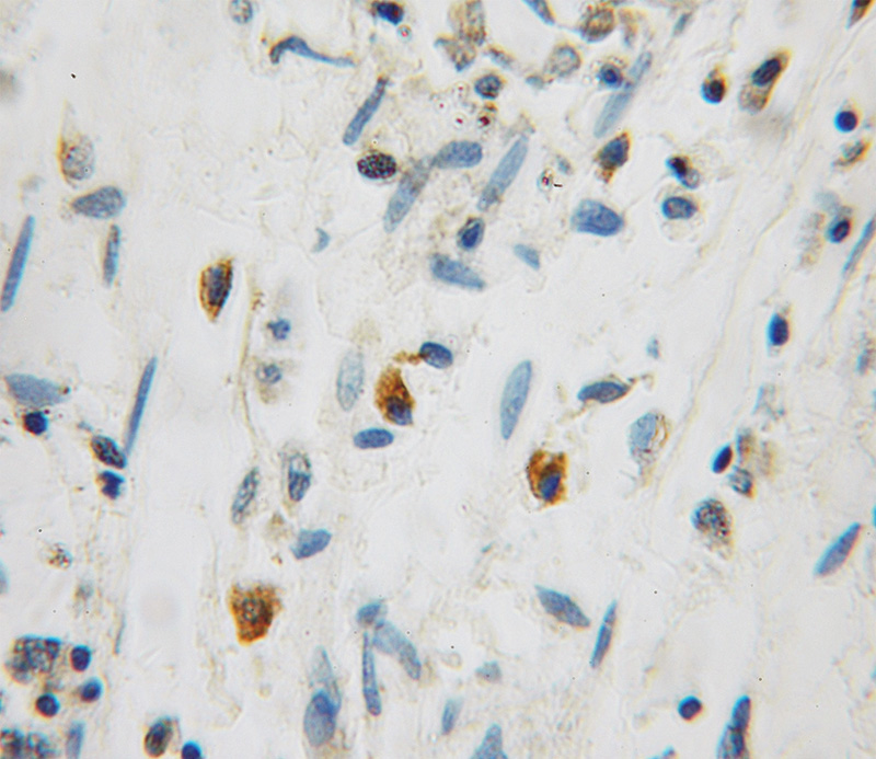 Immunohistochemical of paraffin-embedded human colon cancer using Catalog No:111224(GRPEL1 antibody) at dilution of 1:100 (under 10x lens)