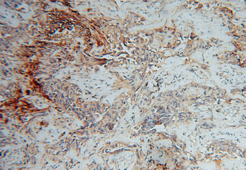 Immunohistochemical of paraffin-embedded human lung cancer using Catalog No:111757(IMMP2L antibody) at dilution of 1:100 (under 10x lens)