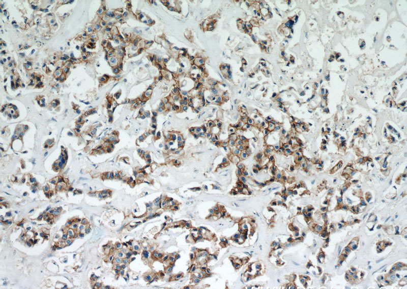 Immunohistochemical of paraffin-embedded human breast cancer using Catalog No:107956(ALCAM antibody) at dilution of 1:50 (under 10x lens)
