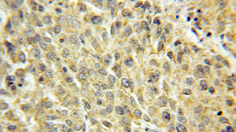 Immunohistochemical of paraffin-embedded human lung cancer using Catalog No:115024(SCYL3 antibody) at dilution of 1:50 (under 10x lens)
