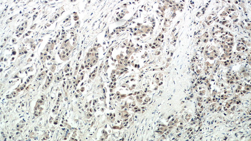 Immunohistochemical of paraffin-embedded human breast cancer using Catalog No:108901(CBLL1 antibody) at dilution of 1:50 (under 10x lens)