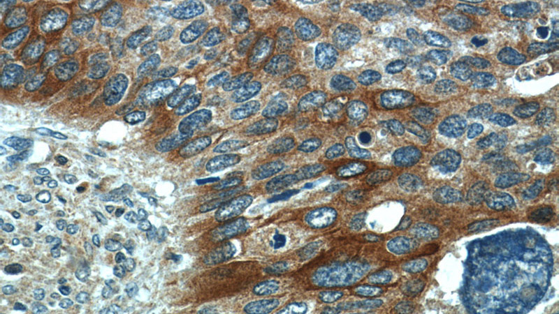 Immunohistochemistry of paraffin-embedded human cervical cancer tissue slide using Catalog No:109797(KRT17 Antibody) at dilution of 1:50 (under 40x lens)