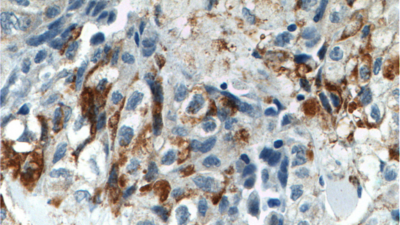 Immunohistochemistry of paraffin-embedded human lung cancer tissue slide using Catalog No:114852(RSPO3 Antibody) at dilution of 1:200 (under 40x lens).