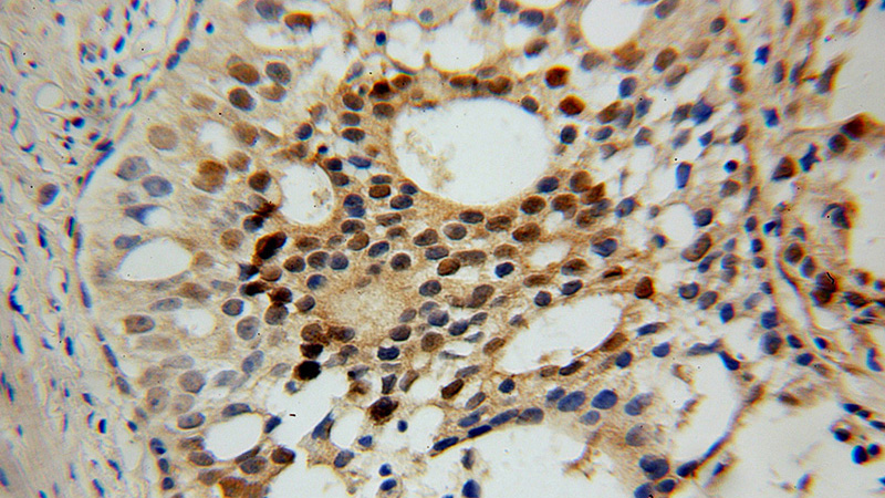 Immunohistochemical of paraffin-embedded human gliomas using Catalog No:108267(ASPA antibody) at dilution of 1:100 (under 10x lens)