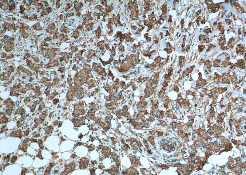 Immunohistochemistry of paraffin-embedded human breast cancer tissue slide using (Cytochrome c Antibody) at dilution of 1:600 (under 10x lens). heat mediated antigen retrieved with Tris-EDTA buffer(pH9).