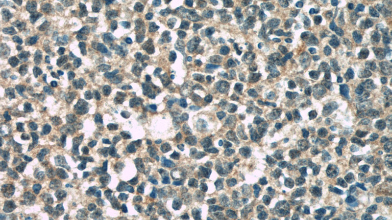 Immunohistochemical of paraffin-embedded human tonsillitis using Catalog No:109027(CD320 antibody) at dilution of 1:50 (under 40x lens)