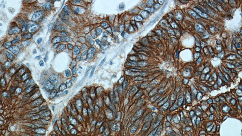 Immunohistochemistry of paraffin-embedded human colon cancer tissue slide using (CDH17 Antibody) at dilution of 1:300 (under 40x lens).