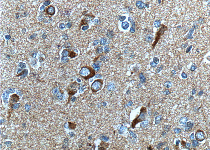 Immunohistochemistry of paraffin-embedded human gliomas tissue slide using Catalog No:107584(APP Antibody) at dilution of 1:200 (under 40x lens). heat mediated antigen retrieved with Tris-EDTA buffer(pH9).