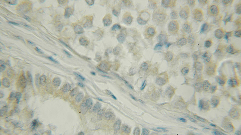 Immunohistochemical of paraffin-embedded human breast cancer using Catalog No:109760(DCTN5 antibody) at dilution of 1:50 (under 10x lens)