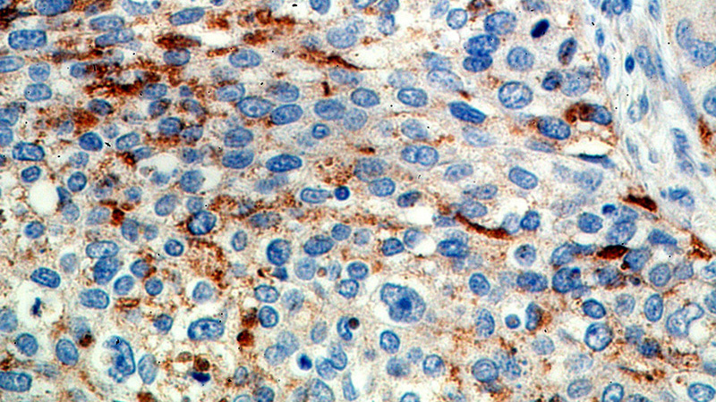 Immunohistochemical of paraffin-embedded human cervical cancer using Catalog No:112822(MRPL3 antibody) at dilution of 1:100 (under 40x lens)