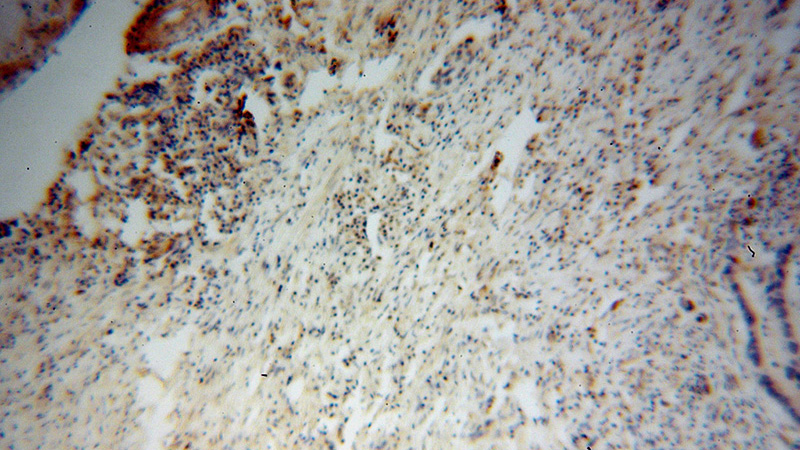 Immunohistochemical of paraffin-embedded human colon cancer using Catalog No:108191(ARID3A antibody) at dilution of 1:100 (under 10x lens)