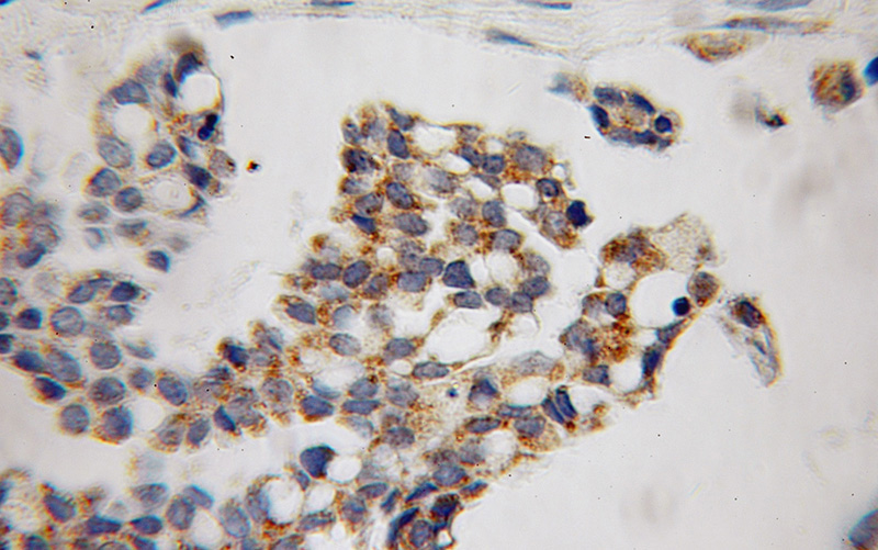 Immunohistochemical of paraffin-embedded human ovary tumor using Catalog No:112427(MAP4K5 antibody) at dilution of 1:100 (under 10x lens)