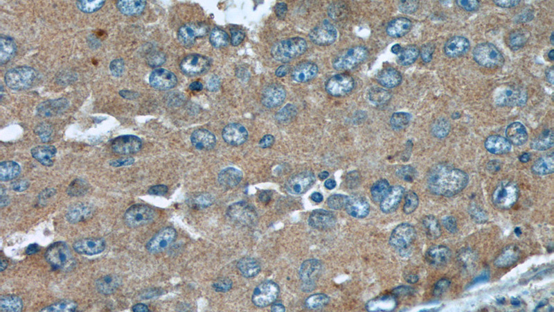Immunohistochemistry of paraffin-embedded human lung cancer tissue slide using Catalog No:116495(TUSC2 Antibody) at dilution of 1:50 (under 40x lens)