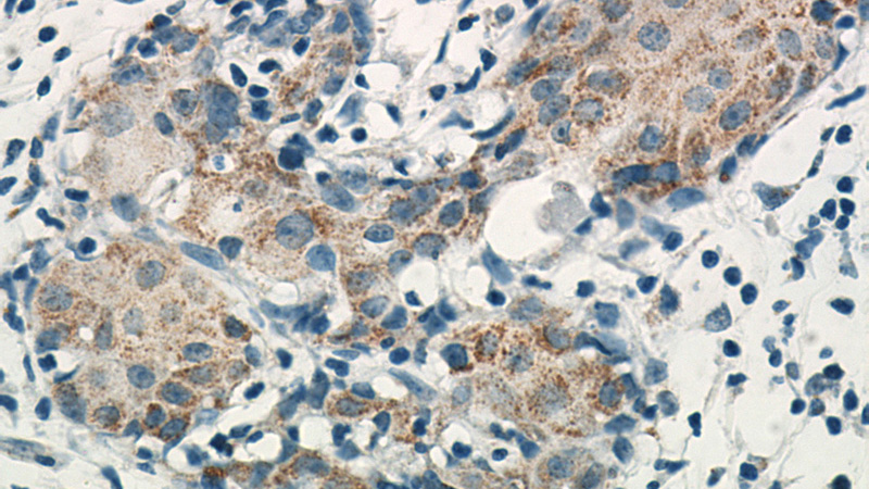 Immunohistochemical of paraffin-embedded human breast cancer using Catalog No:116727(VCPIP1 antibody) at dilution of 1:50 (under 40x lens)