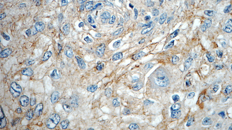 Immunohistochemistry of paraffin-embedded human oesophagus cancer tissue slide using Catalog No:116162(C3orf23 Antibody) at dilution of 1:50 (under 40x lens)
