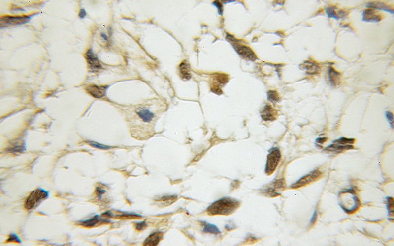 Immunohistochemical of paraffin-embedded human gliomas using Catalog No:116068(TLE1 antibody) at dilution of 1:50 (under 10x lens)