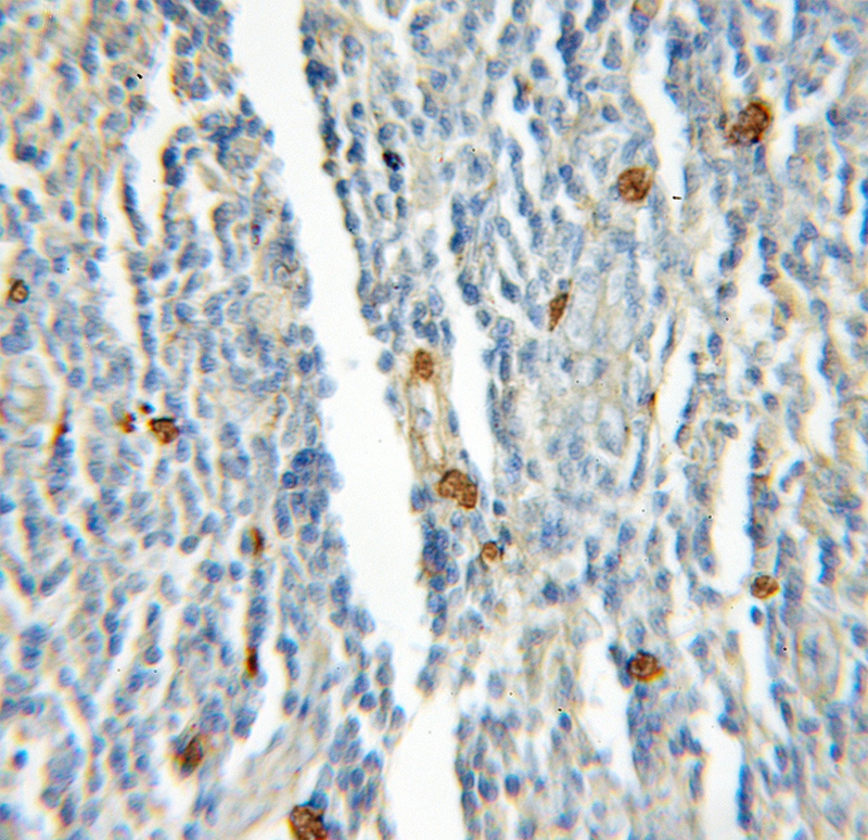 Immunohistochemical of paraffin-embedded human lymphoma using Catalog No:114517(Rad51D antibody) at dilution of 1:100 (under 10x lens)