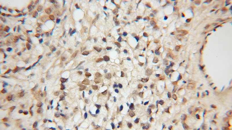 Immunohistochemical of paraffin-embedded human prostate cancer using Catalog No:117237(BRIT1 antibody) at dilution of 1:50 (under 10x lens)