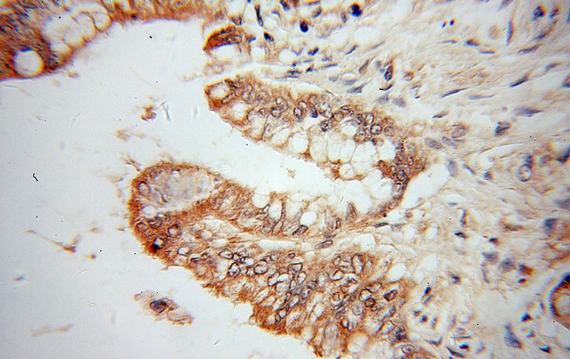 Immunohistochemical of paraffin-embedded human colon cancer using Catalog No:109194(CES3 antibody) at dilution of 1:100 (under 40x lens)
