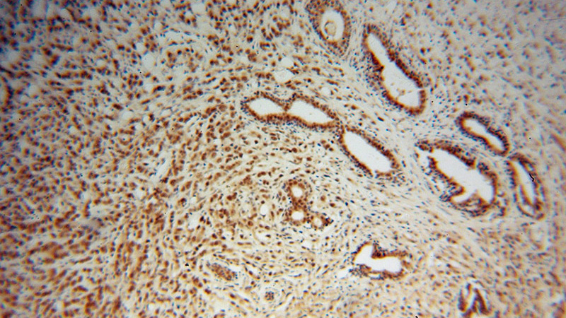Immunohistochemical of paraffin-embedded human prostate cancer using Catalog No:109618(CSTF2T antibody) at dilution of 1:100 (under 10x lens)