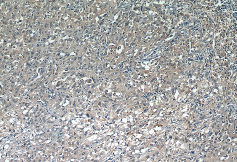 Immunohistochemistry of paraffin-embedded human cervical cancer tissue slide using Catalog No:109114(CDCA3 Antibody) at dilution of 1:50 (under 10x lens)