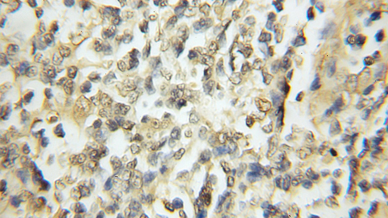 Immunohistochemical of paraffin-embedded human lymphoma using Catalog No:114374(PSMA3 antibody) at dilution of 1:50 (under 10x lens)