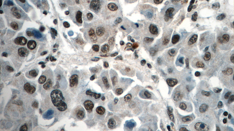 Immunohistochemistry of paraffin-embedded human liver cancer tissue slide using Catalog No:111363(HIST2H2AA4 Antibody) at dilution of 1:50 (under 40x lens)