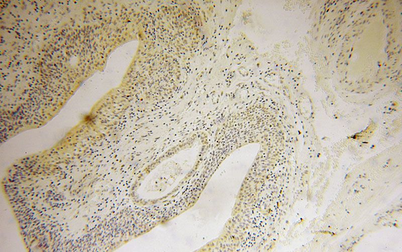 Immunohistochemical of paraffin-embedded human colon cancer using Catalog No:111792(ING2 antibody) at dilution of 1:50 (under 10x lens)