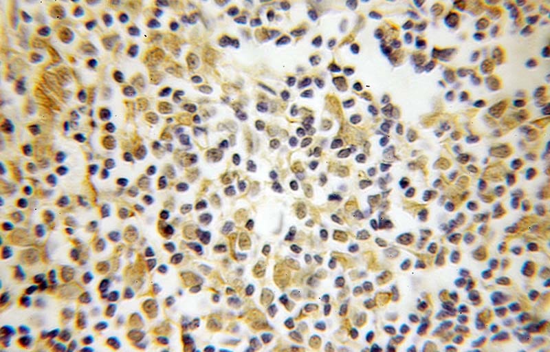 Immunohistochemical of paraffin-embedded human lymphoma using Catalog No:113469(POU2F1 antibody) at dilution of 1:100 (under 25x lens)