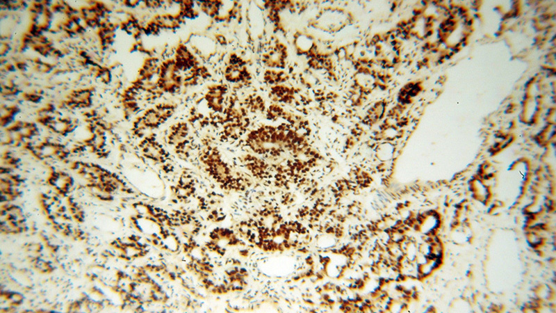 Immunohistochemical of paraffin-embedded human gliomas using Catalog No:115925(TARDBP antibody) at dilution of 1:200 (under 10x lens)