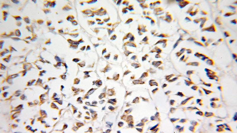 Immunohistochemical of paraffin-embedded human breast cancer using Catalog No:113508(OSTF1 antibody) at dilution of 1:100 (under 25x lens)
