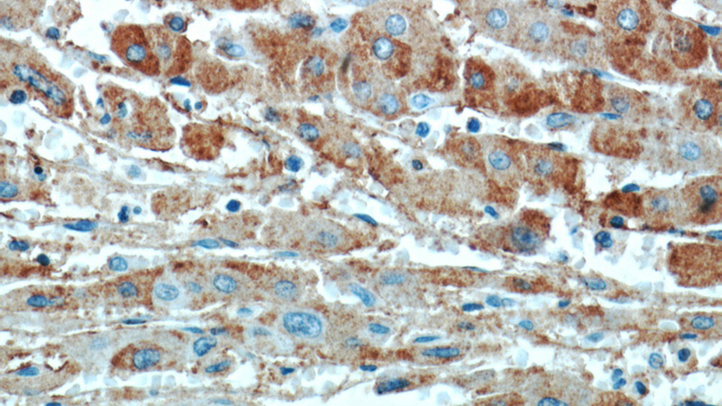 Immunohistochemical of paraffin-embedded human liver cancer using Catalog No:110300(EDC4 antibody) at dilution of 1:50 (under 40x lens)