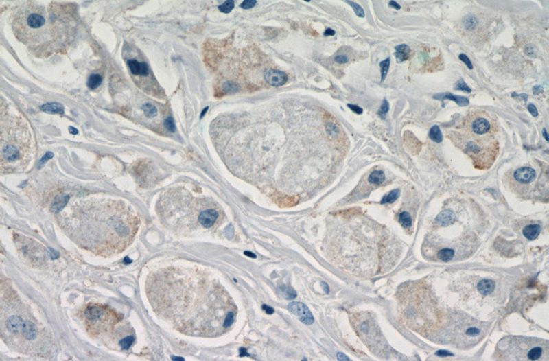 Immunohistochemistry of paraffin-embedded human breast cancer slide using Catalog No:109922(DHRS11 Antibody) at dilution of 1:50(under 40x lens)