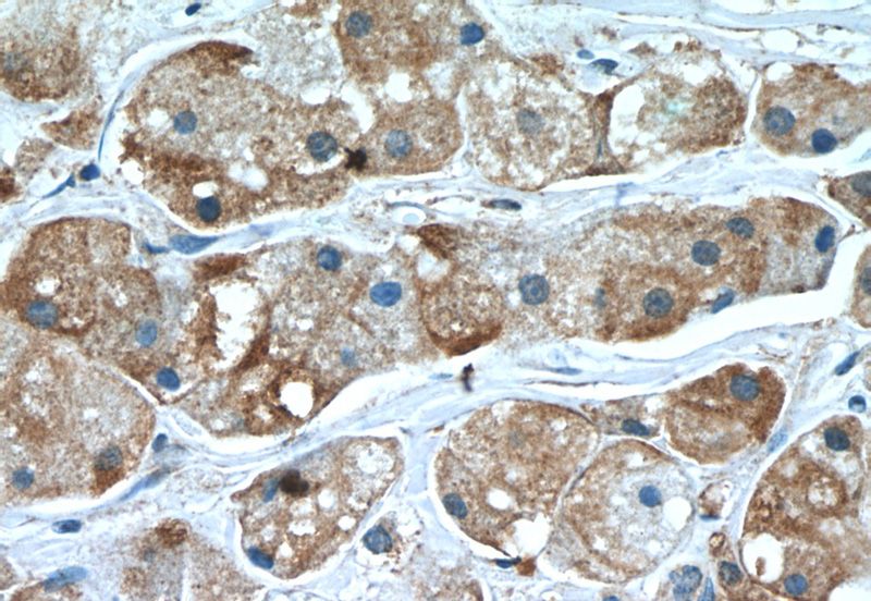 Immunohistochemistry of paraffin-embedded human breast cancer slide using Catalog No:116193(TMEM59 Antibody) at dilution of 1:50 (under 40x lens)