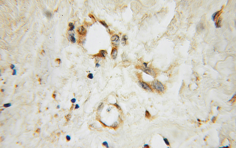 Immunohistochemical of paraffin-embedded human breast cancer using Catalog No:115082(SEC5 antibody) at dilution of 1:100 (under 10x lens)