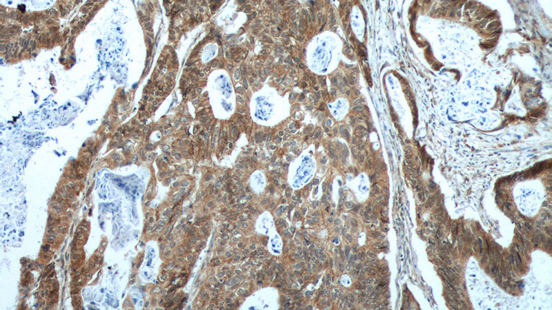 Immunohistochemistry of paraffin-embedded human colon cancer tissue slide using Catalog No:113533(CTNND1 Antibody) at dilution of 1:200 (under 10x lens). heat mediated antigen retrieved with Tris-EDTA buffer(pH9).