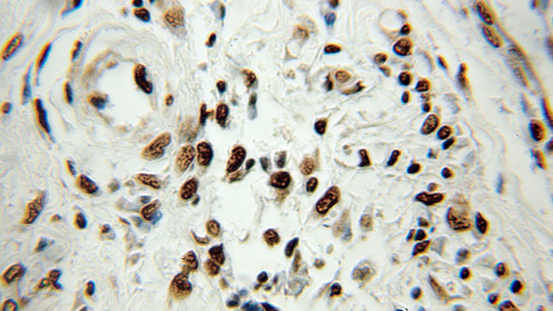 Immunohistochemical of paraffin-embedded human colon cancer using Catalog No:111500(HNRNPA1 antibody) at dilution of 1:100 (under 10x lens)