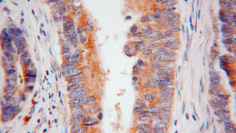 Immunohistochemical of paraffin-embedded human colon cancer using Catalog No:107717(ACAD9 antibody) at dilution of 1:50 (under 40x lens)