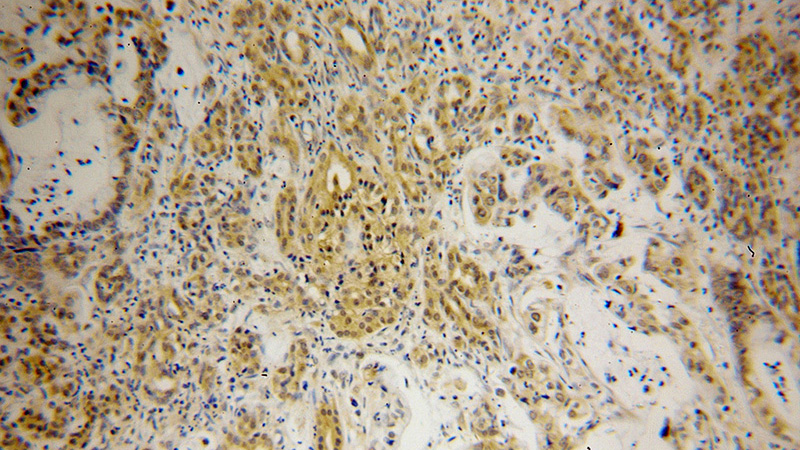 Immunohistochemical of paraffin-embedded human pancreas cancer using Catalog No:113913(PIP4K2B antibody) at dilution of 1:100 (under 10x lens)