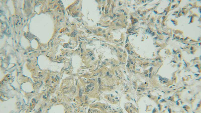 Immunohistochemical of paraffin-embedded human prostate cancer using Catalog No:111321(GYS1 antibody) at dilution of 1:50 (under 25x lens)