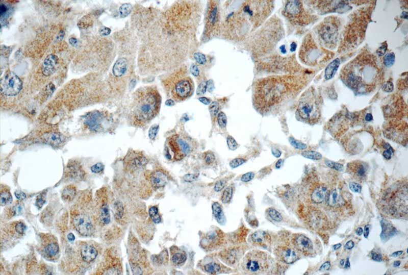 Immunohistochemistry of paraffin-embedded human liver cancer tissue slide using Catalog No:114490(RB1CC1 Antibody) at dilution of 1:50 (under 40x lens)