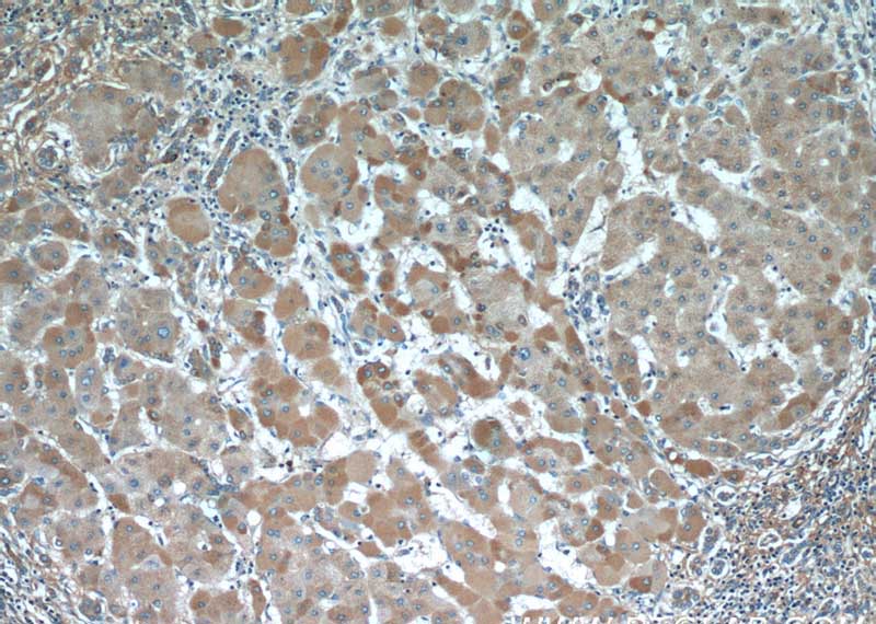 Immunohistochemistry of paraffin-embedded human hepatocirrhosis tissue slide using Catalog No:107877(A2M Antibody) at dilution of 1:50 (under 10x lens)
