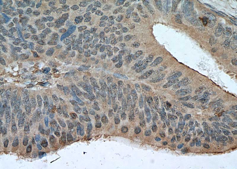 Immunohistochemistry of paraffin-embedded human colon cancer tissue slide using Catalog No:107529(Sestrin2 Antibody) at dilution of 1:200 (under 40x lens). heat mediated antigen retrieved with Tris-EDTA buffer(pH9).