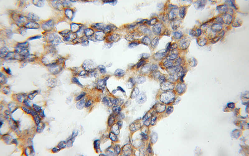 Immunohistochemical of paraffin-embedded human breast cancer using Catalog No:114535(RAMP3 antibody) at dilution of 1:50 (under 10x lens)