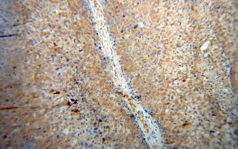 Immunohistochemical of paraffin-embedded human skin cancer using Catalog No:114899(RPL7 antibody) at dilution of 1:100 (under 10x lens)