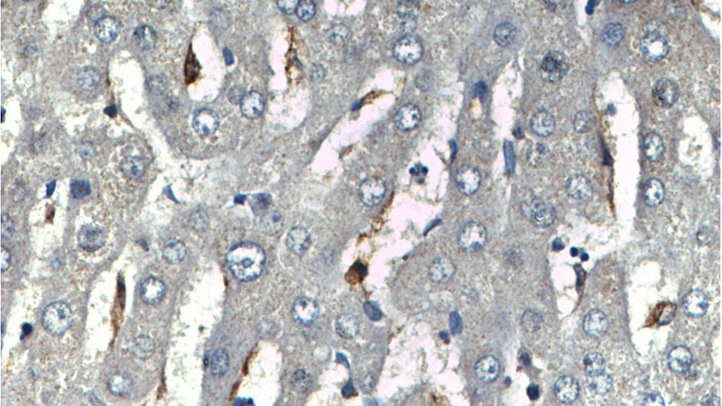 Immunohistochemistry of paraffin-embedded human liver tissue slide using (CD68 Antibody) at dilution of 1:200 (under 40x lens)