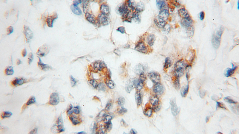 Immunohistochemical of paraffin-embedded human pancreas cancer using Catalog No:113629(PDLIM1,CLP36 antibody) at dilution of 1:50 (under 10x lens)