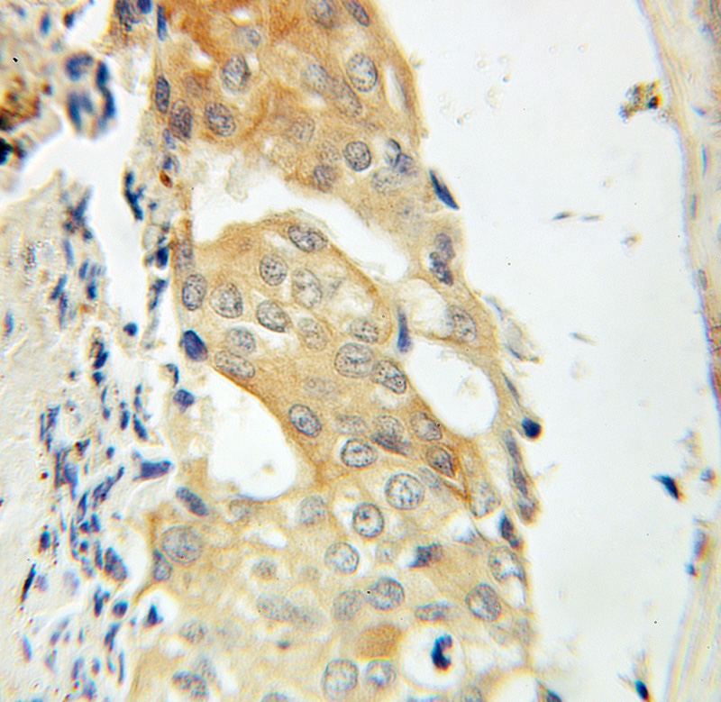 Immunohistochemical of paraffin-embedded human breast cancer using Catalog No:109425(CNKSR1 antibody) at dilution of 1:100 (under 40x lens)