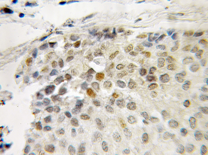 Immunohistochemical of paraffin-embedded human breast cancer using Catalog No:112381(MAGEA4 antibody) at dilution of 1:50 (under 10x lens)
